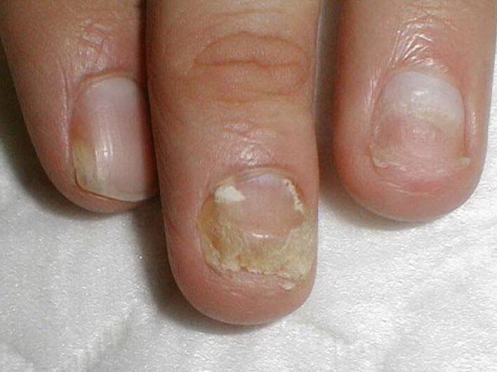 Candida trattamento fungo delle unghie