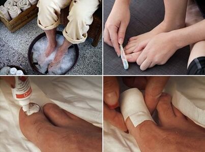 Lenire i piedi e applicare la crema all'urea sulle unghie colpite da funghi