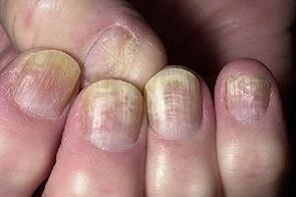 Cambiamenti delle unghie con infezione fungina