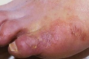 Manifestazioni di un'infezione fungina sulla pelle delle gambe
