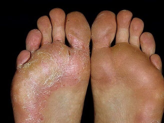 Sintomi di un fungo sul piede