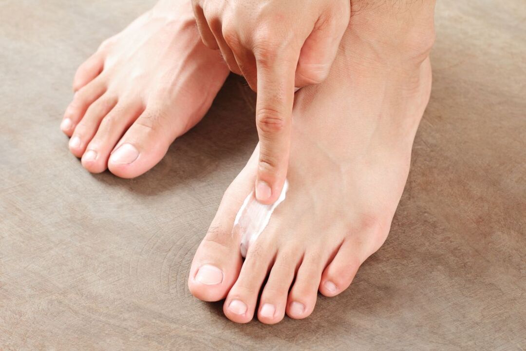 Trattamento del fungo sui piedi con unguento