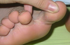 Funghi tra le dita dei piedi