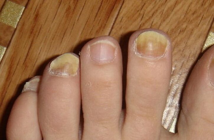 Sintomi di funghi sulle unghie e sulla pelle dei piedi