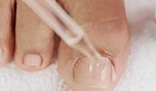 Gocce per il fungo delle unghie dei piedi