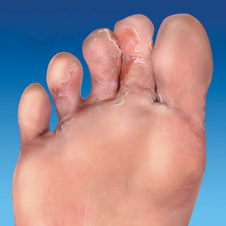 fungo della pelle dei piedi