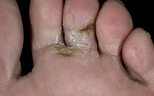 tipi di fungo del piede